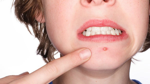 Como Tratar Espinhas e Acne